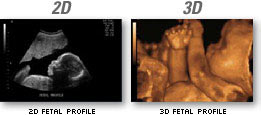 3d vs 4d ultrasound